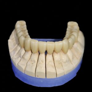 Implantatversorgung in der Zahntechnik1