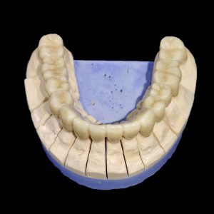Implantatversorgung in der Zahntechnik2