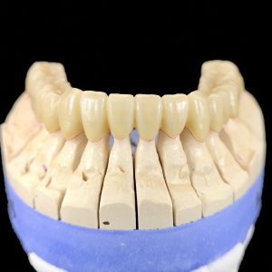 Implantatversorgung in der Zahntechnik3
